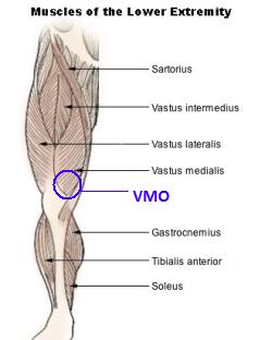 The VMO knee cap muscles are extremely important for controlling how the patella moves