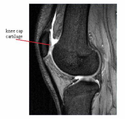 Chondromalacia Patella occurs when there is softening and damage to the cartilage lining the back of the kneecap.