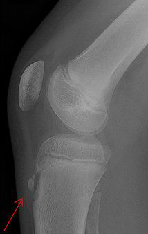 Osgood Schlatter Disease is caused by friction and damage just below the kneecap