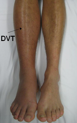 DVT's usually present with pain, swelling, redness and warmth in the calf region