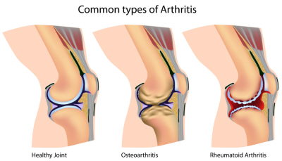 What causes bumps on the femur bone?