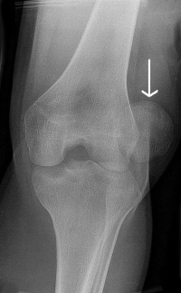 What is the rehab for a fractured patella?