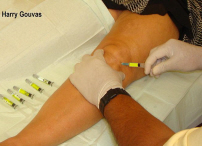 What are some risks to getting Synvisc injections for arthritis of the knees?