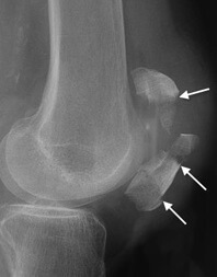 What is the rehab for a fractured patella?