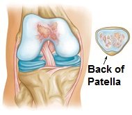 With kneecap arthritis there is wear and tear of the cartilage on the back of the patella and in the patella groove on the thigh bone