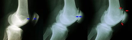 Patellofemoral arthritis. Left image shows a normal knee, middle image shows loss of joint space between the femur and patella due to arthritis. Right image highlights bone spurs due to arthritis.