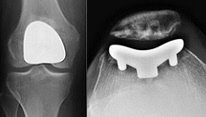 X-ray showing a patellofemoral replacement