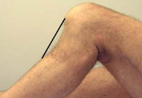 Classic presentation of a PCL injury - one of the less common knee injuries Classic presentation of a PCL injury - one of the less common knee injuries