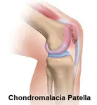 chondromalacia patella 280 opt sept 18