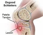 osgood schlatter lesion 340 opt sept 18