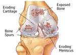 knee arth treatment 424 opt dec 23