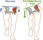 trendelenberg gait weak hip 390 opt aug 25