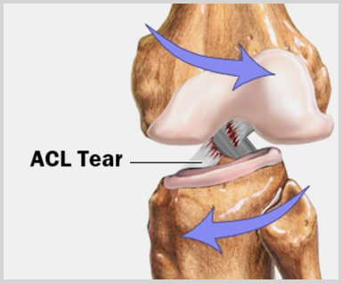 ACL Knee Injury - causes, symptoms, diagnosis and treatment ACL Knee Injury - causes, symptoms, diagnosis and treatment