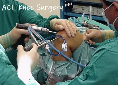 surgery acl