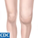 Swollen Knee: Causes, Diagnosis & Treatment