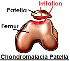 Chondromalacia Patella can cause a grinding sensation at the knee