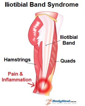The iliotibial band and site of injury at lateral epicondyle of