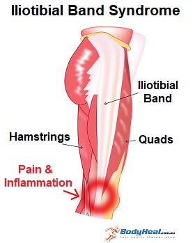 Iliotibial Band Syndrome: Symptoms, Causes & Treatment