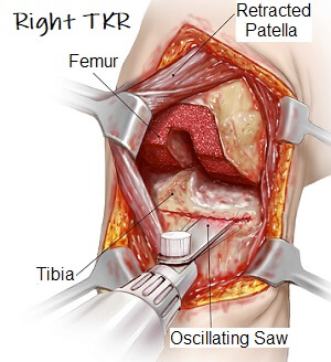 Knee Replacement Surgery Video: What Happens - Knee Pain Explained