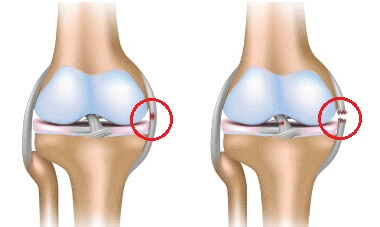 Diagram of the knee ligaments showing a complete MCL tear (medial collateral ligament)