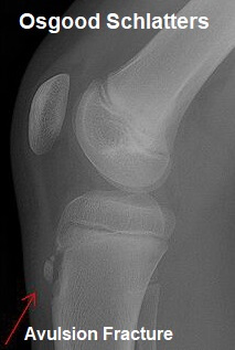 Osgood Schlatter Disease é causada por atrito e dano logo abaixo da rótula Doença de Osgood Schlatter