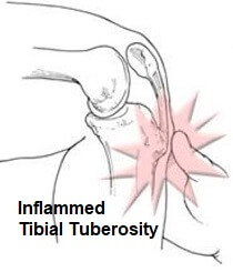 Na doença de Osgood-Schlatter, o tubérculo tibial aumentado e inflamado é quase sempre sensível quando a pressão é aplicada. Na doença de Osgood-Schlatter, o tubérculo tibial aumentado e inflamado é quase sempre sensível quando a pressão é aplicada.