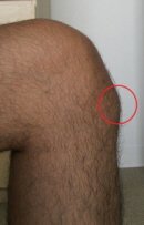 Doença de Osgood Schlatter