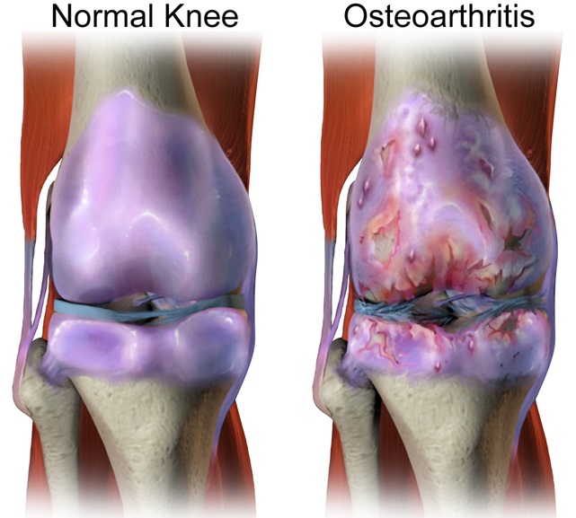 Stiff Knee After Sitting: Causes and Treatments