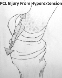 A PCL Injury due to hyperextension