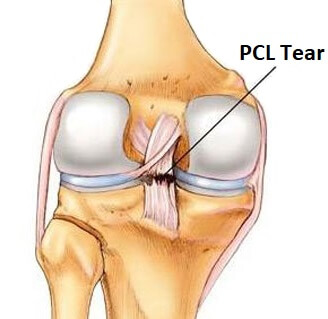 Knee Injury Diagnosis Chart