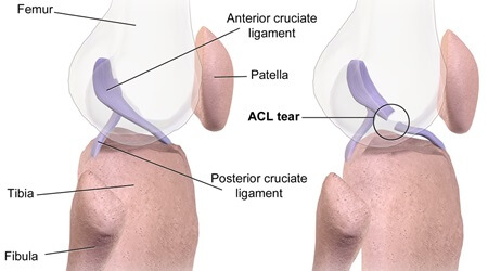 Side on view of an ACL knee injury