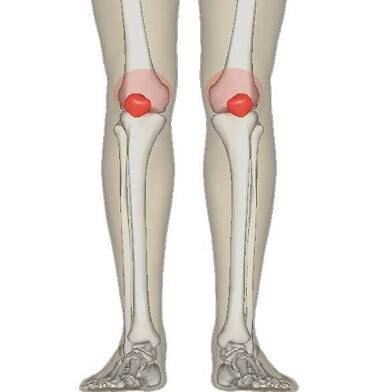 Above Knee Pain: Patellofemoral Pain Syndrome. Causes, symptoms, diagnosis and treatment options for Runner's Knee