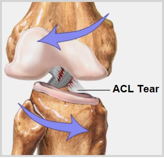 Knee Injury Diagnosis Chart