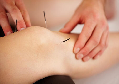 Acupuncture can be used to treat knee arthritis, helping to reduce pain and inflammation Acupuncture can be used to treat knee arthritis, helping to reduce pain and inflammation