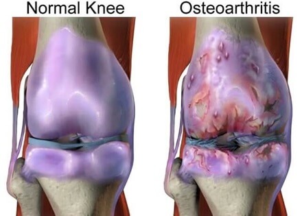 Alternative medicine for arthritis is becoming increasingly popular. Find out what works best Alternative medicine for arthritis is becoming increasingly popular. Find out what works best