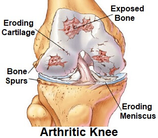 Knee Symptoms Chart