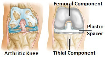 Total knee joint replacement involves removing the worn parts of the joint and replacing them.