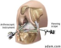 acl surgery new procedure acl surgery new procedure