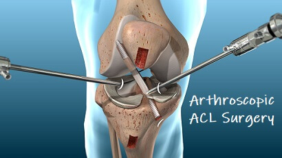 Arthroscopic picture of left knee revealing (a) bulky anterior cruciate