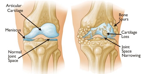 Elbow (Olecranon) Bursitis: Symptoms, Causes & Treatment