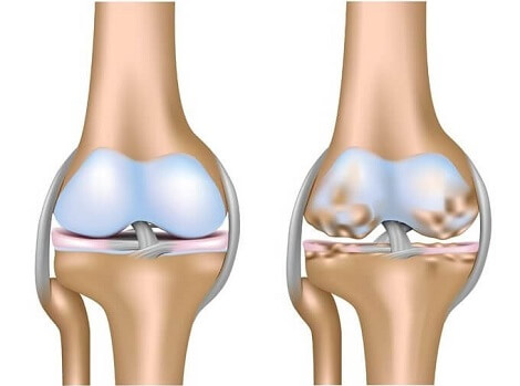 Heel Spurs - Causes, Symptoms & Treatment– Bauerfeind Australia