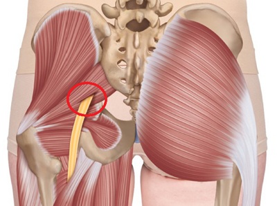 Burning hip pain at night is often caused by piriformis syndrome. Tightness in the piriformis muscle in the buttocks places pressure on the sciatic nerve Burning hip pain at night is often caused by piriformis syndrome. Tightness in the piriformis muscle in the buttocks places pressure on the sciatic nerve