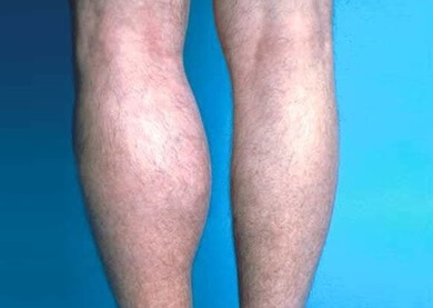 A Bakers Cyst is a collection of fluid behind the knee that often causes calf muscle pain A Bakers Cyst is a collection of fluid behind the knee that often causes calf muscle pain