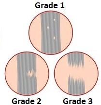Muscle tears can be classified into 3 grades depending on the severity of the injury