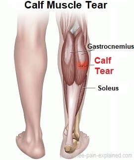 Calf muscle tear