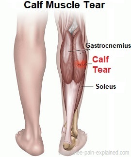 Calf Muscle Tear Treatment - Knee Pain Explained