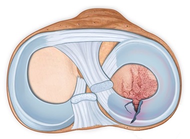 A meniscus tear is a common cause of back of knee pain.