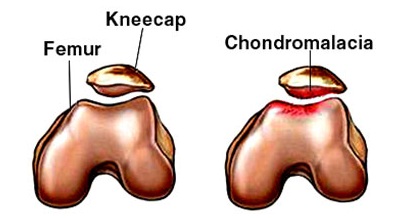 Chondromalacia Patella can cause a grinding or clicking sensation at the knee due to cartilage damage