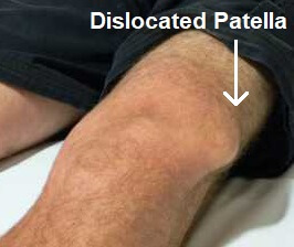 dislocated-patella-presentation.jpg