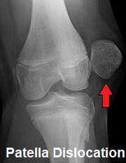 X-ray showing a laterally dislocated patella